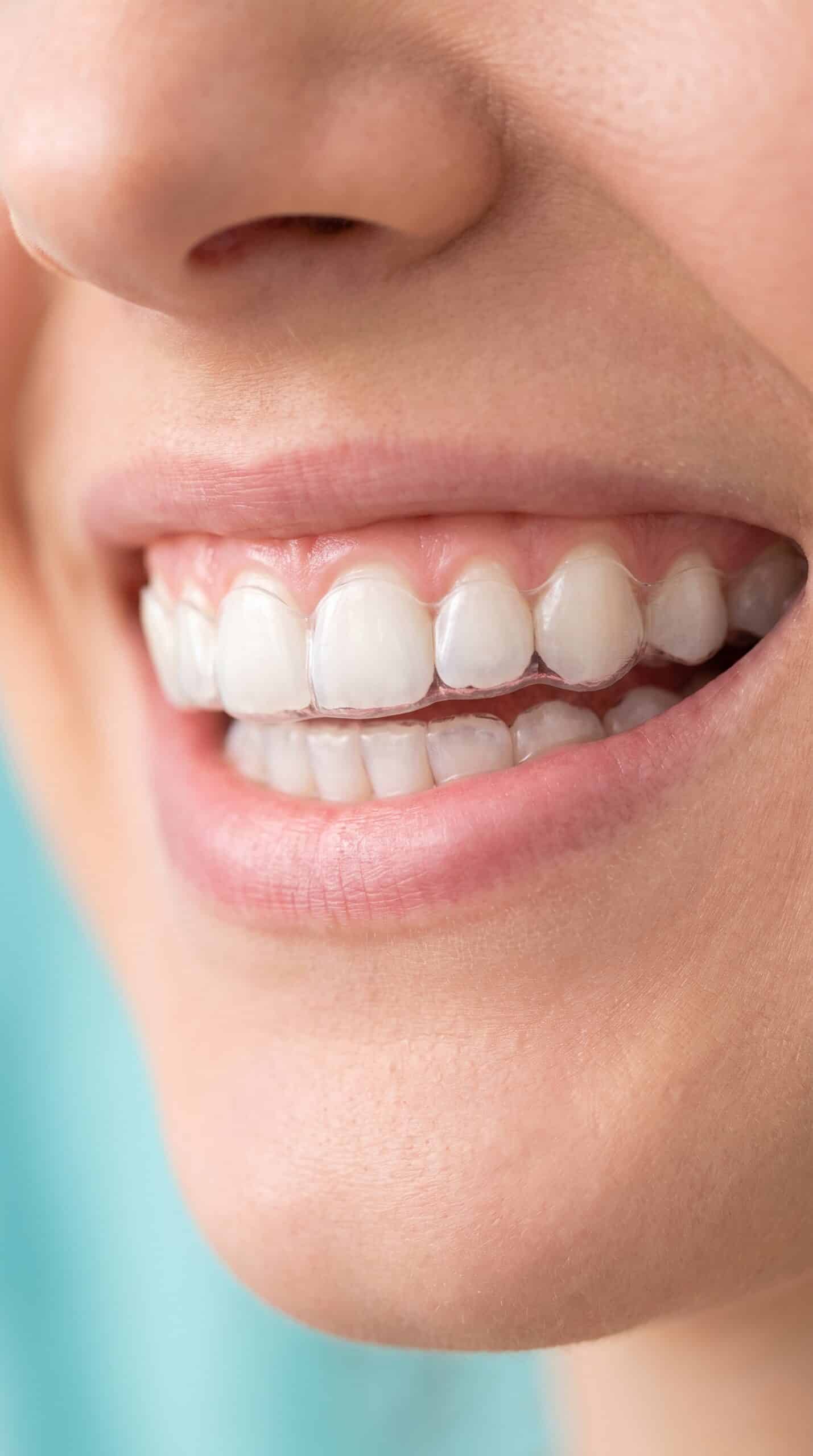 Illustration d'un sourire à la teinte naturellement claire, avec une gouttière d'éclaircissement transparente portée sur les dents du haut