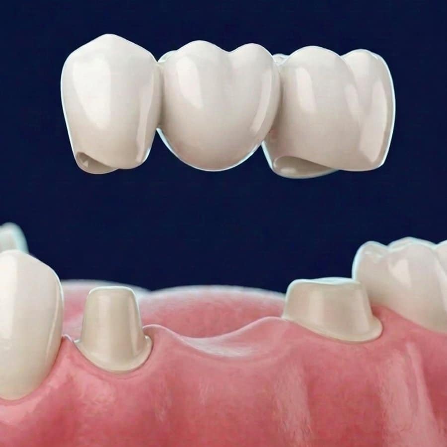 Illustration 3D d'un bridge de trois éléments au-dessus de deux dents taillées entourant un espace vide