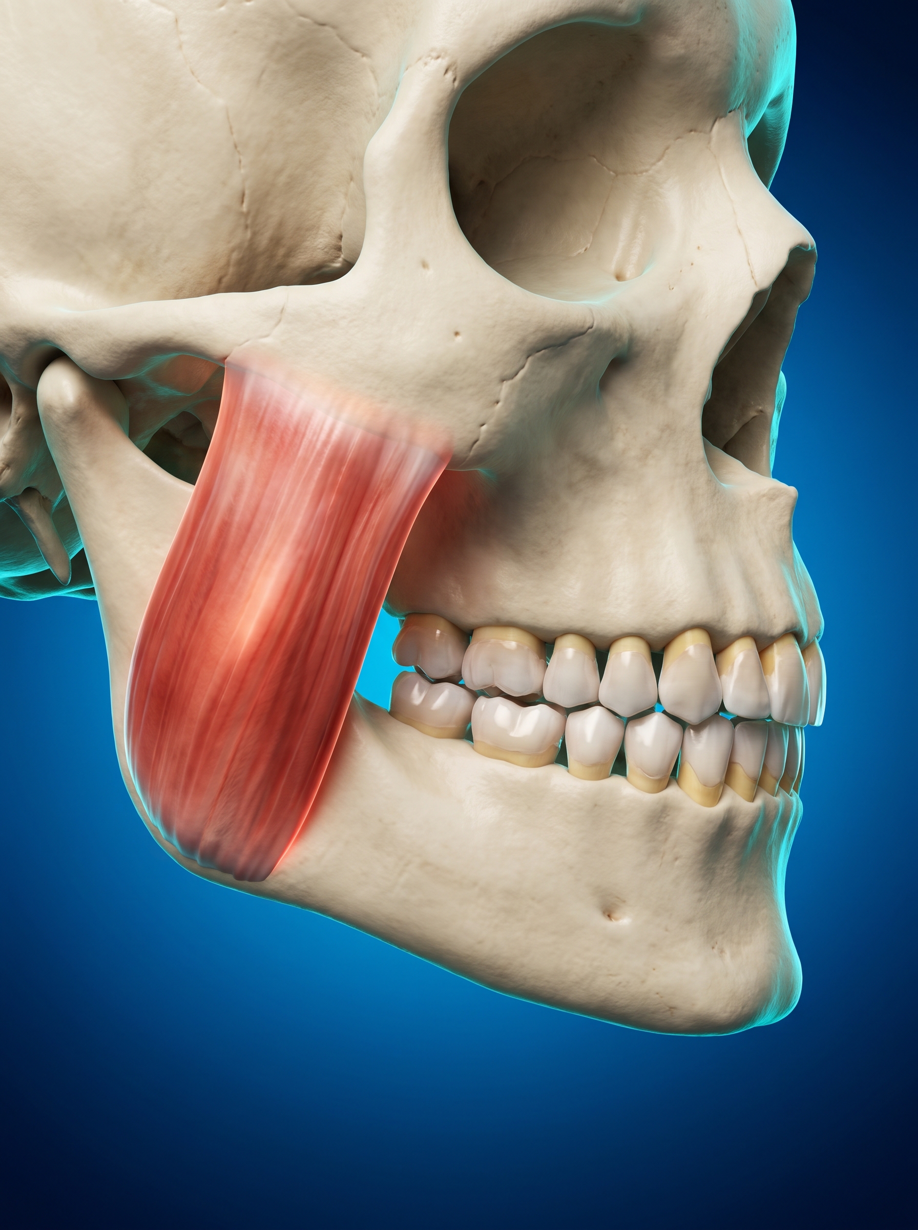 Rendu anatomique d'un crâne de profil, dents serrées, avec le muscle masséter mis en évidence entre la pommette et l'angle de la mâchoire