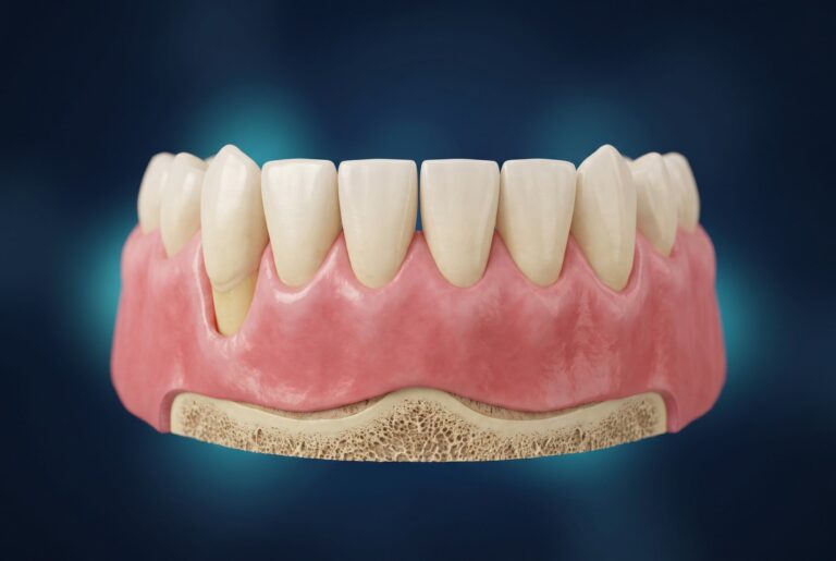 Récession gingivale sur une canine inférieure : la gencive s'est rétractée et découvre la racine