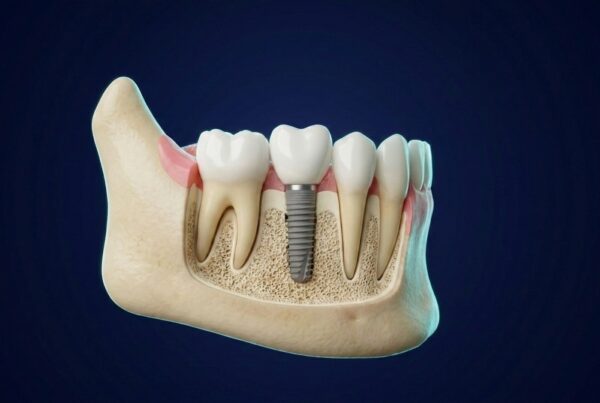 Coupe 3D d'une mâchoire avec un implant dentaire et sa couronne