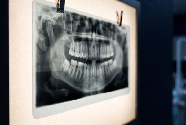 Radiographie panoramique éclairée, dent de sagesse inclinée au centre