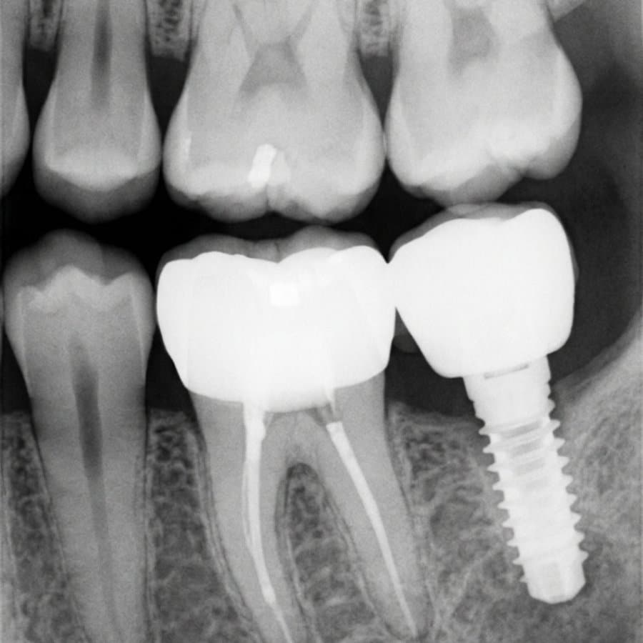 Radiographie dentaire rétro-alvéolaire montrant une couronne avec traitement de racine et un implant